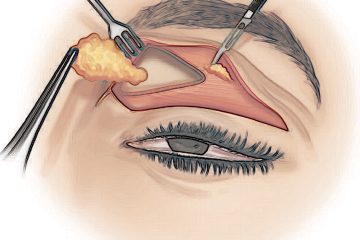 Blefaroplastia: Rejuvenescendo o Olhar com Cirurgia nas Pálpebras